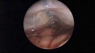 Endoscopic fenestration of cerebellar arachnoid cyst [upl. by Vivyan201]