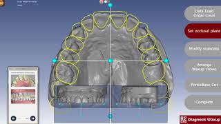 R2CAD Diagnostic wax upEn [upl. by Slade]