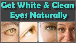 How To Get Clean Eyes Top 10 Methods For Whitening Of Eyes And 10 Foods For Yellow Eyes [upl. by Akcimat]