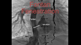 Fontan fenestration [upl. by Keeley]