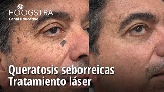 Queratosis seborreicas  Tratamiento láser  22340 [upl. by Ennoryt]