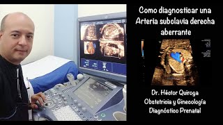 Ecocardiografía fetal Como diagnosticar una arteria subclavia derecha aberrante [upl. by Tab80]