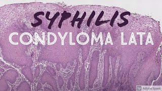 Condyloma Lata Syphilis 5Minute Pathology Pearls [upl. by Annekcm]