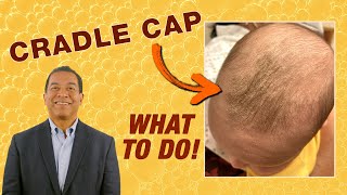 Cradle Cap Pediatrician’s Tips for Parents Seborrheic Dermatitis  AAP [upl. by Newo]