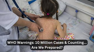 Measles Cases Surge Worldwide Alarming Stats amp Key Prevention Measures [upl. by Narine856]