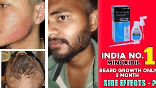 India no1 minoxidil review  mintop minoxidil for beard growth  mintop minoxidil 5 beard growth [upl. by Burford]