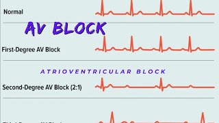 Atrioventricular Block  AV block Causes and Types [upl. by Patience911]