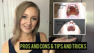 Palate Expander As An Adult Pros and Cons amp Tips and Tricks BEFORE AND AFTER [upl. by Janeta]