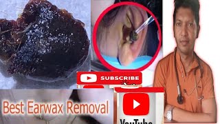 best earwax remover [upl. by Yrogreg]