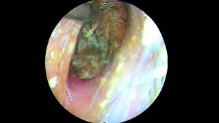 Ear picking Cleaning earwax asmr ear cleaning wax in your ear Ear health  ear piercing cleaning [upl. by Kikelia]