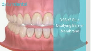 OSSIX PLUS Resorbable Collagen Dental Membrane 2014 [upl. by Bocoj]