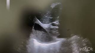 Ultrasound of Subdiaphragmatic abscess [upl. by Arrekahs]