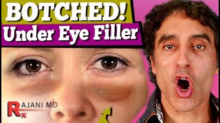 BOTCHED UNDER EYE FILLER  Under Eye Filler [upl. by Descombes801]