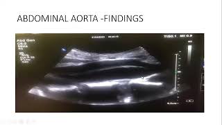 Abdominal Aortic Dissection  Case Report [upl. by Stempien]