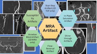 The TOF MRA Artifact  What is it [upl. by Notsuoh]