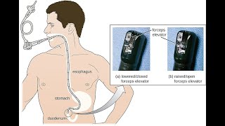 Esophagogastroduodenoscopy CPT code  simplify medical coding [upl. by Eissert472]