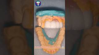 Ceramic Teeth  Upper Anterior  Maxillary Insicor  PFM  Tamil Dental Lab  tamildentist shorts🦷 [upl. by Zebedee]