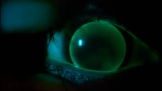 Instructional Video Assessment of a Gas Permeable Contact Lens [upl. by Godbeare]