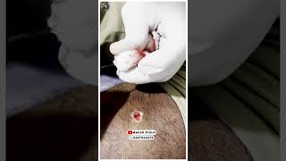 Get Rid of Warts Quickly and Easily Easy and PainlessAWISH Clinic [upl. by Lynad]