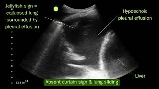 Lung ultrasound  Simple pleural effusion VS hydropneumothorax [upl. by Pacifa]