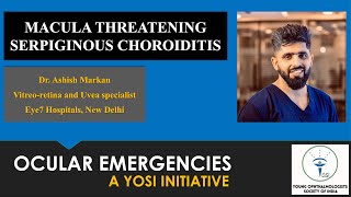 Macula Threatening Serpiginous Choroiditis  Dr Ashish Markan  YOSI Ocular Emergency  Episode 19 [upl. by Ahsienad]