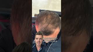 Amazing Hair Loss Transformation hairlosstreatment hairloss [upl. by Jessee]