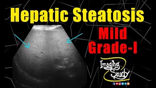 Mild Hepatic Steatosis  GradeI Fatty Liver  Ultrasound  Case 226 [upl. by Iuqcaj841]