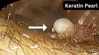 Keratin pearls in ear canal  bilateral symmetrical  without surgery [upl. by Llerrehs839]