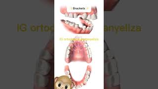 Extractions in orthodontics orthodontictips ортодонтия kieferorthopädie ortodonzia orthodontie [upl. by Kerad930]