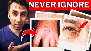 Doctor Explains 4 Skin Signs of High Cholesterol Real Life Photos [upl. by Asin]