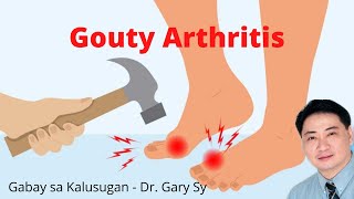 Gouty Arthritis  Dr Gary Sy [upl. by Ohnuj]