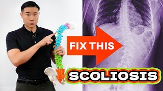 Escape the Scoliosis Surgery Trap Discover Proactive Solutions BeatScoliosis [upl. by Gorrian]