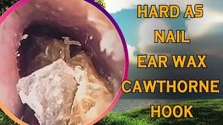 Hard as nails earwax vs cawthorne hook with ear wax removal [upl. by Rettig61]