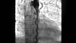 Coarctation of Aorta with Large Collaterals AP view [upl. by Chloris552]