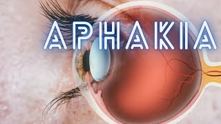 Aphakia  Ophthalmology Lecture [upl. by Aiblis]