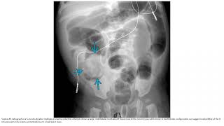 Ileocolic Intussusception Imaging [upl. by Dovev]