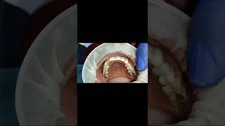 Upper first premolar implant crown GRAPHENE cad cam milled [upl. by Yllen]