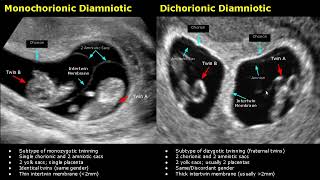 Fetal Twins Ultrasound Normal Vs Abnormal  MonochorionicDichorionicDiamnioticMonoamniotic USG [upl. by Ragucci]