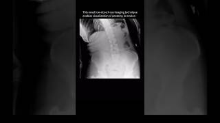 Spine movement seen for the FIRSTTIME with dynamic XRay backpain anatomy [upl. by Medea]