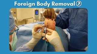 Foreign Body Removal Surgery [upl. by Oznol]