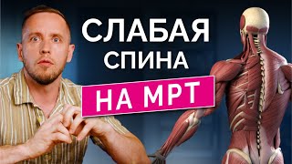 Эволюция подарила нам остеохондроз Объясняю на МРТ почему разрастаются суставы и болит спина [upl. by Otilopih]