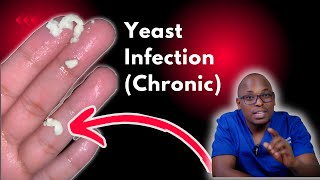 Chronic Yeast Infections  Recurrent yeast Infections  Causes signs and symptoms Treatment [upl. by Elleirua]