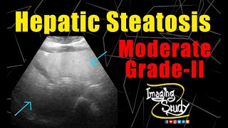 Moderate Hepatic Steatosis  GradeII Fatty Liver  Ultrasound  Case 222 [upl. by Jumbala]