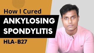 How I Cured My Ankylosing Spondylitis  Ayurvedic Treatment [upl. by Anialeh961]