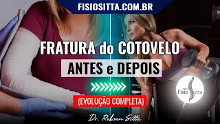 COTOVELO TRATAMENTO COMPLETO FRATURA e NEUROPRAXIA RADIAL PÓS OPERATÓRIO  Dr Robson Sitta [upl. by Hank]