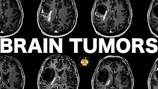 Brain Tumors [upl. by Feldt]