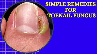 Natural Ayurvedic Home Remedies for Toenail Fungus  How to Treat Nail Fungus  Natural Cures System [upl. by Zohara211]