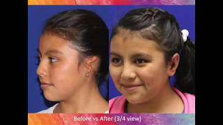 Domenica Before amp After Microtia Ear Surgery [upl. by Adnana]