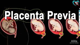 Placenta Previa Definition Cause Type Sign SymptomsFull Explanation in Hindi  By NG Medicals [upl. by Naeloj]