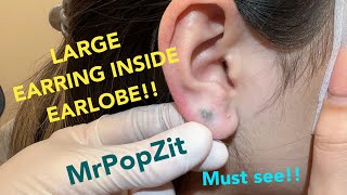 Giant earring completely hidden inside earlobeForeign body popMetal extractionMust see to believe [upl. by Teirtza]